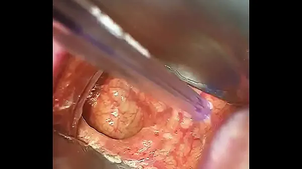 Tubo de transmissão Cirurgia anal novo